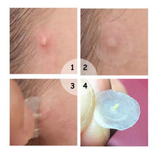 Load image into Gallery viewer, Breylee Acne Pimple Master Patch
